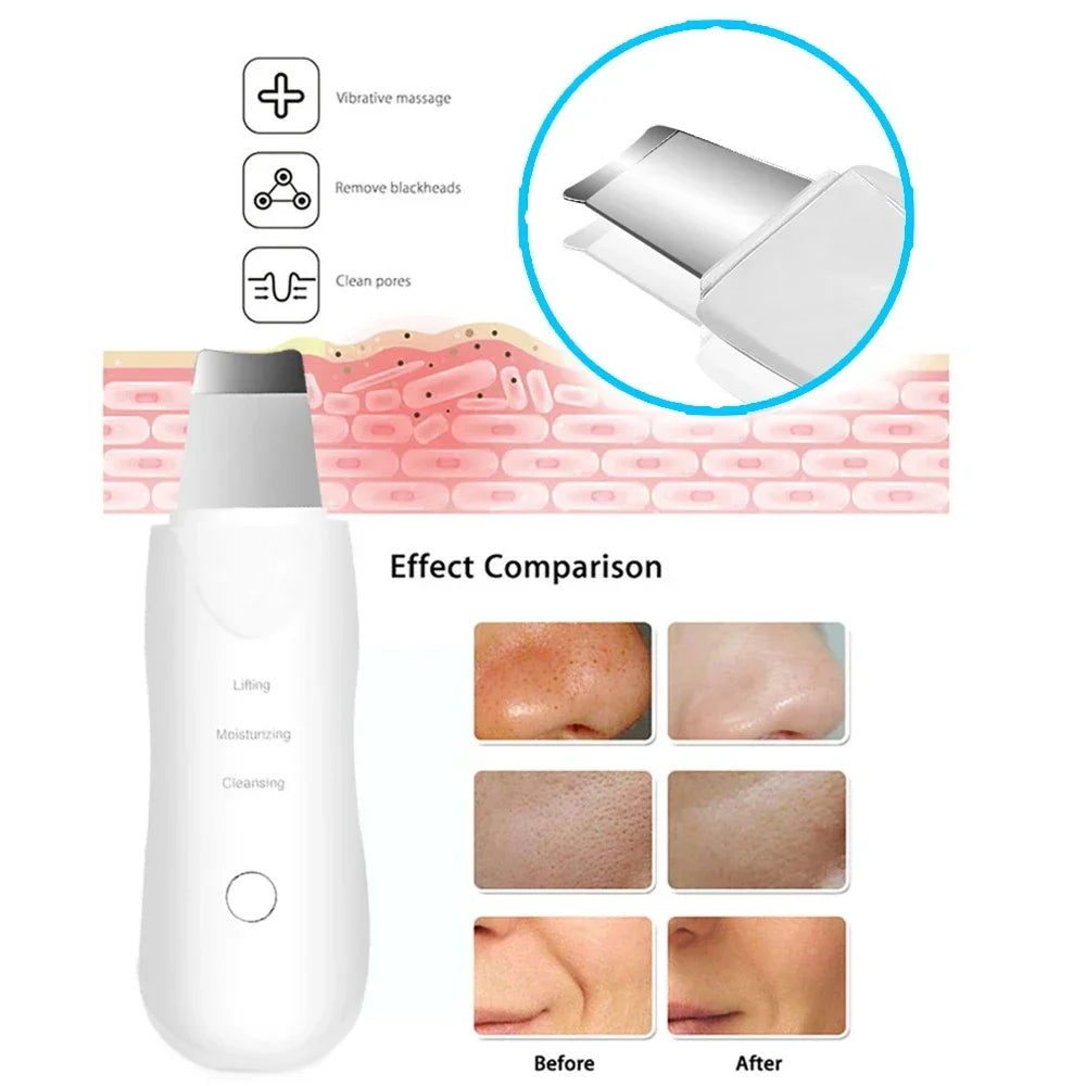 Professional Ultrasonic Facial Skin Scrubber – Deep Cleansing & Gentle Exfoliation Device